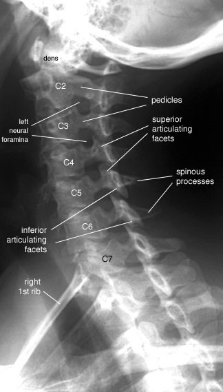 Radiographic Anatomy of the Skeleton: Cervical Spine -- Left Anterior