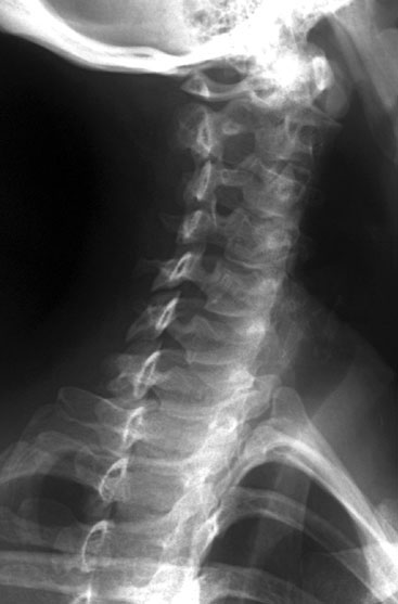 Radiographic Anatomy of the Skeleton: Cervical Spine -- Right Anterior