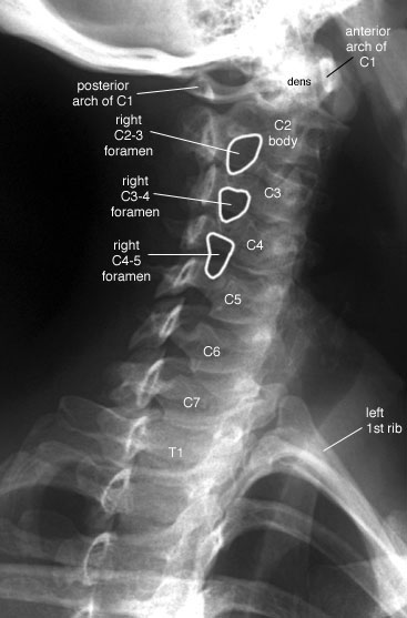 Radiographic Anatomy of the Skeleton: Cervical Spine -- Right Anterior