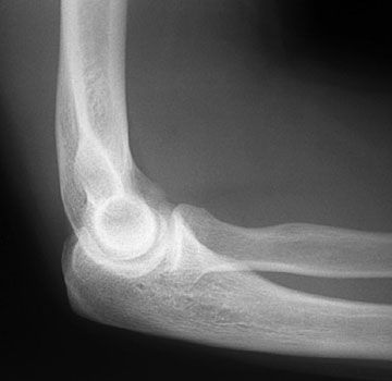 Radiographic Anatomy of the Skeleton: Elbow -- Lateral View, Unlabelled