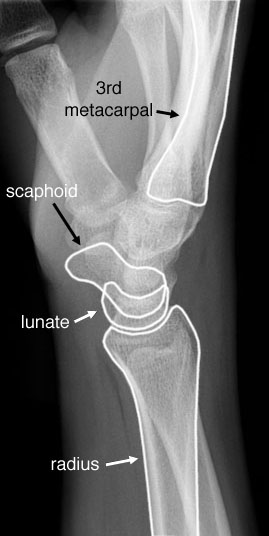 Radiographic Anatomy of the Skeleton: Wrist -- Lateral View, Labelled