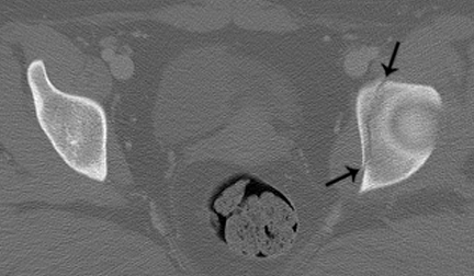 Transverse Fractures
