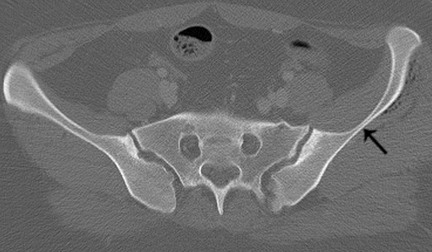 Transverse Fractures