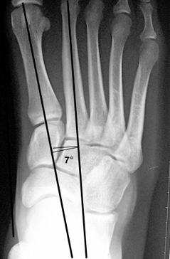 a. Normal 1st-2nd intermetatarsal angle.