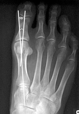 a. Normal 1st metatarsophalangeal angle.