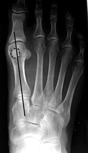 a. Medial sesamoid overlapping less than 50% of mid-axis line, corresponding to Station 1, which is within normal limits.