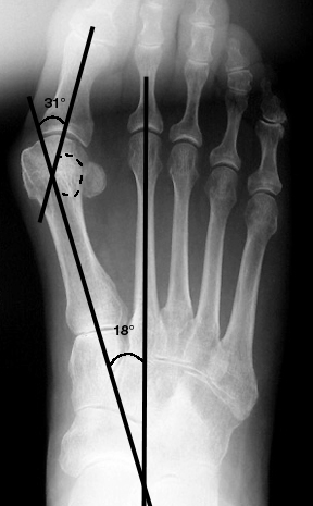 a. Moderate hallux valgus, with increased 1st metatarsophalangeal angle, 1st-2nd intermetatarsal angle, and Station 2 position of the sesamoid.
