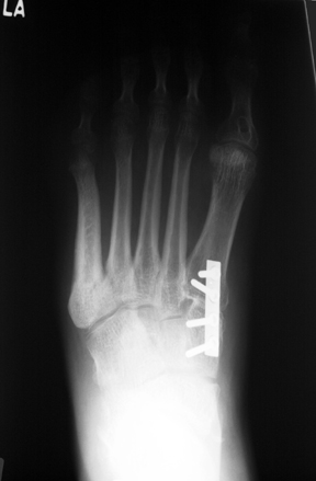 a. Arthrodesis of the first tarsometatarsal joint to reduce plantar flexion of the first ray.