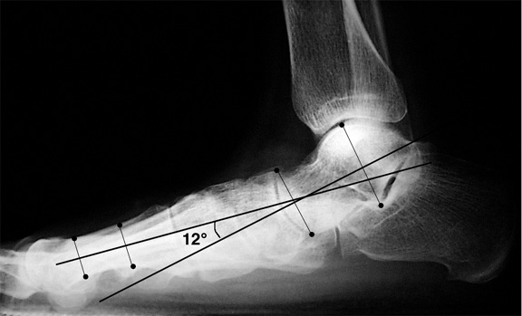 b. The long axis of the talus is angled plantarward in relation to the first metatarsal, consistent with pes planus.