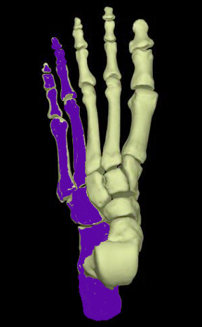 lateral column