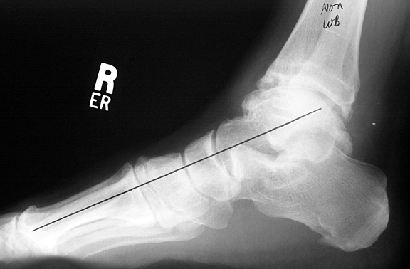 Non weight-bearing: Normal alignment