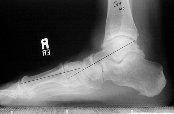 Simulated weight-bearing: Mild pes planus (flatfoot)