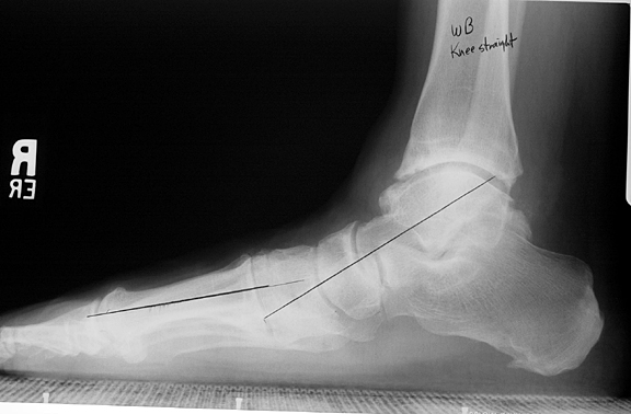 Full weight-bearing: severe pes planus