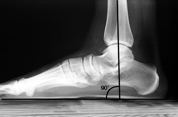 Full weight-bearing. The tibia is perpendicular to the floor.