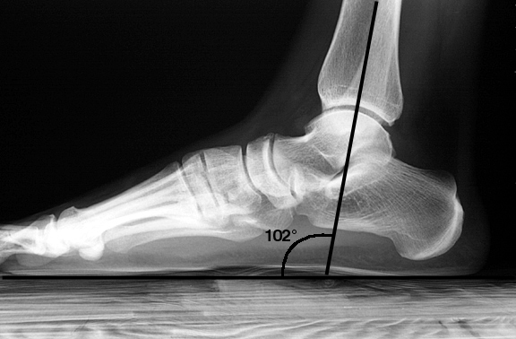 Partial weight-bearing. Note that the tibia is angled relative to the floor.