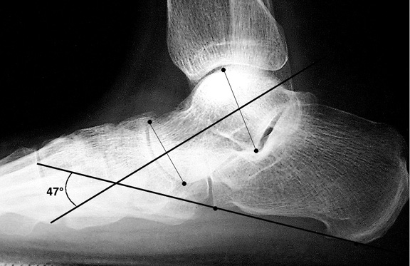 b. Increased talocalcaneal angle indicaitng hindfoot valgus in pes planus.