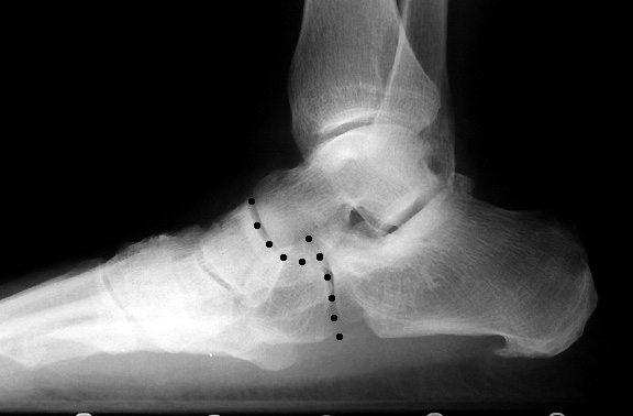 b. Broken Cyma line of pes planus.