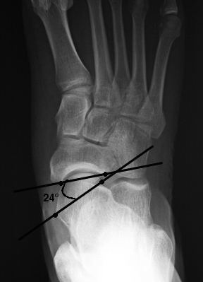 a. AP view showing lateral peritalar subluxation.