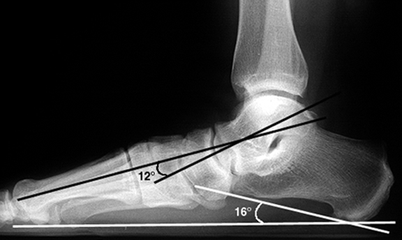 a. Abnormal lateral talar-1st metatarsal angle (black) and calcaneal pitch (white) indicating pes planus.