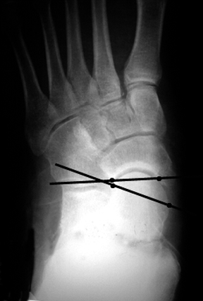 a. Preoperative view of a patient with symptomatic pes planus showing abnorma talonacicular uncoverage.