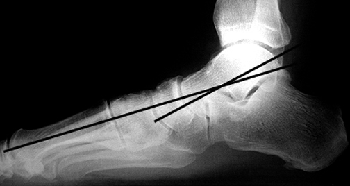 a. Abnormal lateral talar-1st metatarsal angle (black) indicating pes planus.