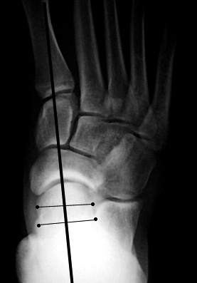 a. Normal talar-1st metatarsal angle on AP view.