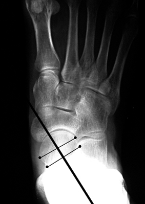 b. Abnormal talar-1st metatarsal angle, angled medial to the first metatarsal.
