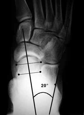 a. Normal AP talocalcaneal angle.