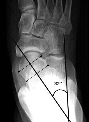 b. Abnormally increased AP talocalcaneal angle, indicating hindfoot valgus in pes planus.
