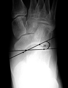 b. Abnormal medial peritalar subluxation