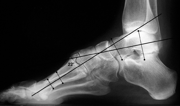 b. Abnormal Meary's angle, convex upward, indicating pes cavus.