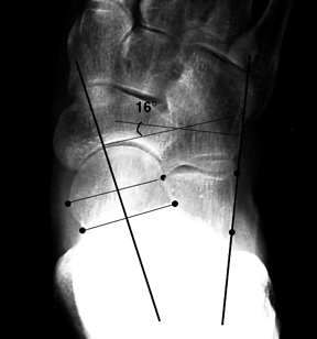 a. Normal AP talocalcaneal angle.