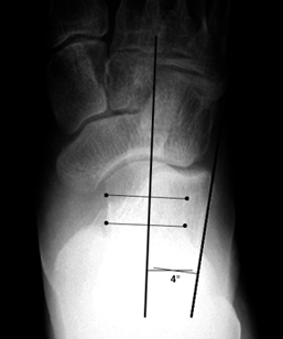 b. Abnormally decreased talocalcaneal angle, indicating hindfoot varus.
