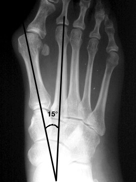 b. Abnormally large 1st-2nd intermetatarsal angle, greater than 9°, consistent with metatarsu primus varus.