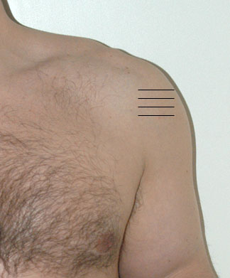 Anterior left shoulder