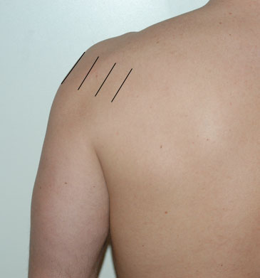 Posterior left shoulder