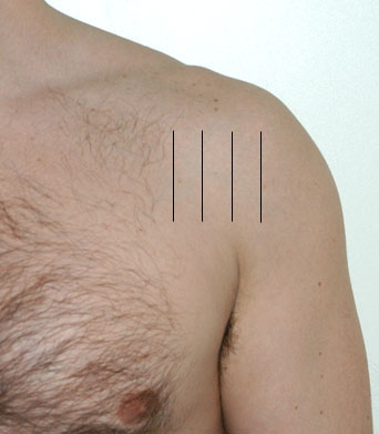 Posterior left shoulder