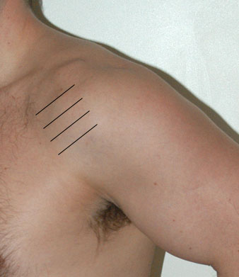 Posterior left shoulder
