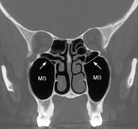 Maxillary Sinus: Normal Anatomy & Variants