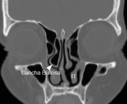 Maxillary Sinus: Normal Anatomy & Variants