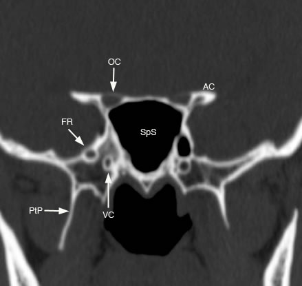 Sphenoid Sinus: Normal Anatomy & Variants