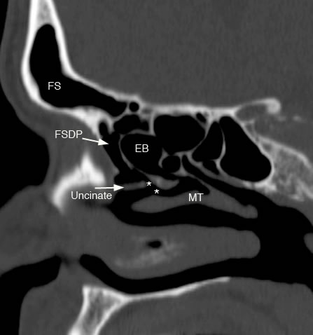 Maxillary Sinus: Normal Anatomy & Variants